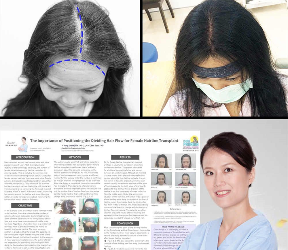 台灣植髮枝術   ISHRS全球發表女性植髮更安全   美型自然無負擔