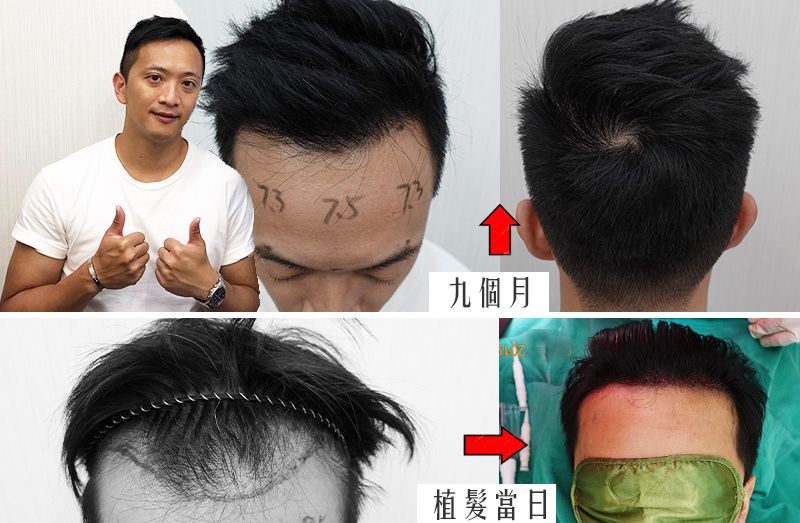 長髮免剃輕鬆植髮  免尷尬! 費用親民!