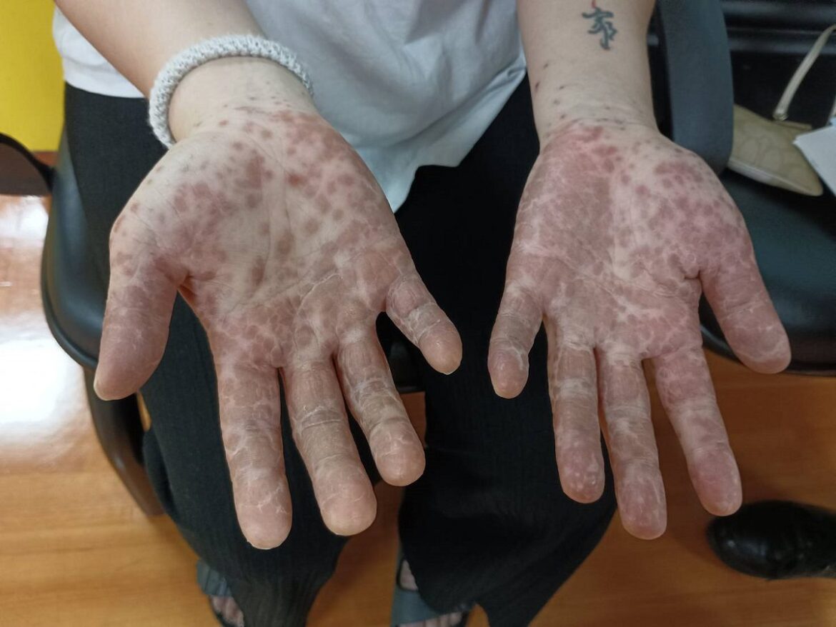 大人也會染上腸病毒要輕忽　小心嚴重者出現密密麻麻的紅疹怵目驚心
