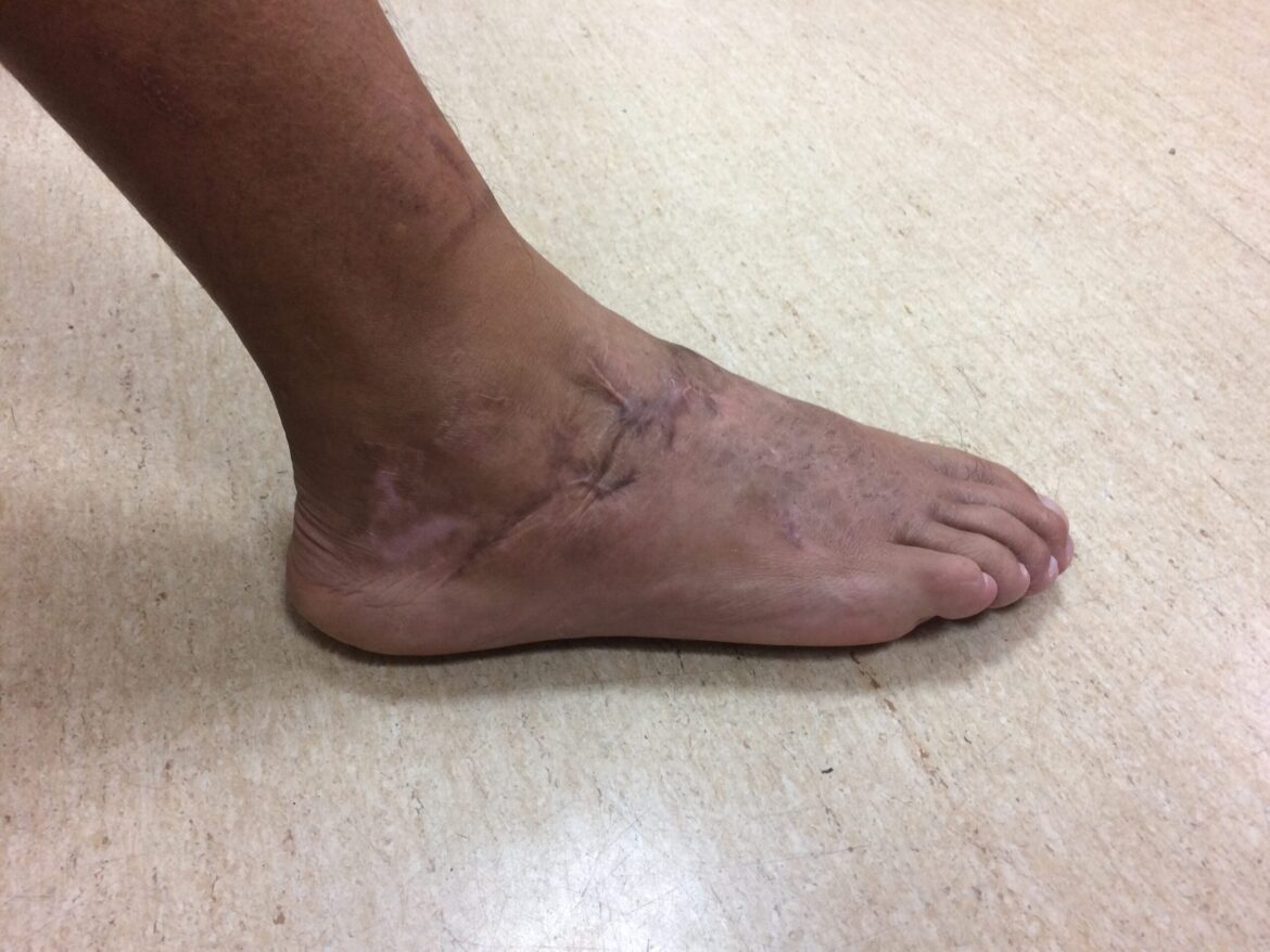 男子出車禍足踝被削平！　醫師馬拉松精準接合