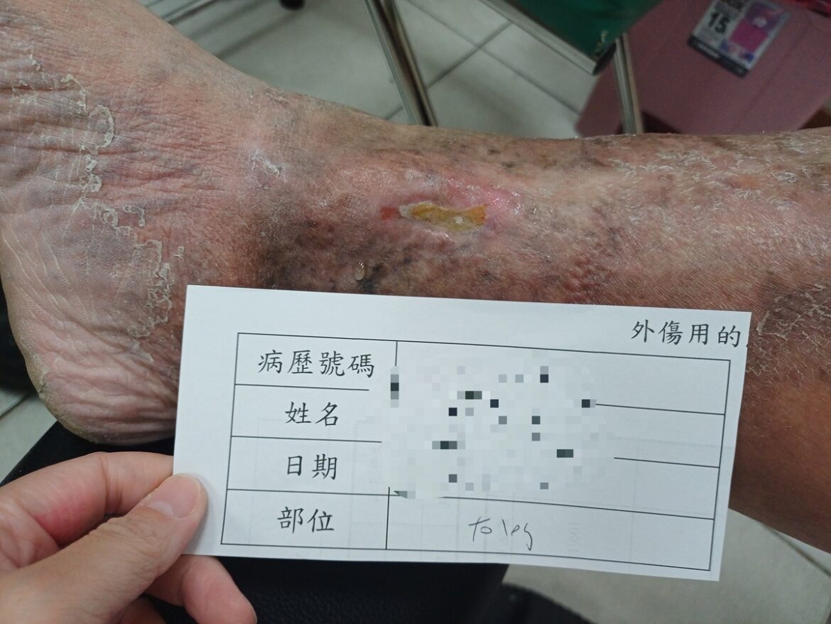 足踝傷口潰爛十多年   求診員榮醫師解決長年困擾