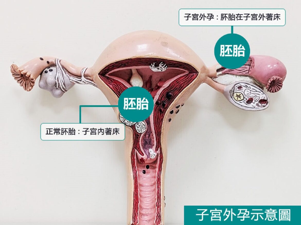子宮外孕奪命風險高　東港安泰醫院成功搶救休克孕婦