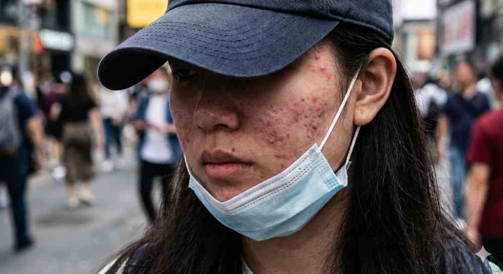 滿臉「痘」花好焦慮！痘疤、凹疤怎處理？誰適合痘疤手術？醫提「4大」關鍵