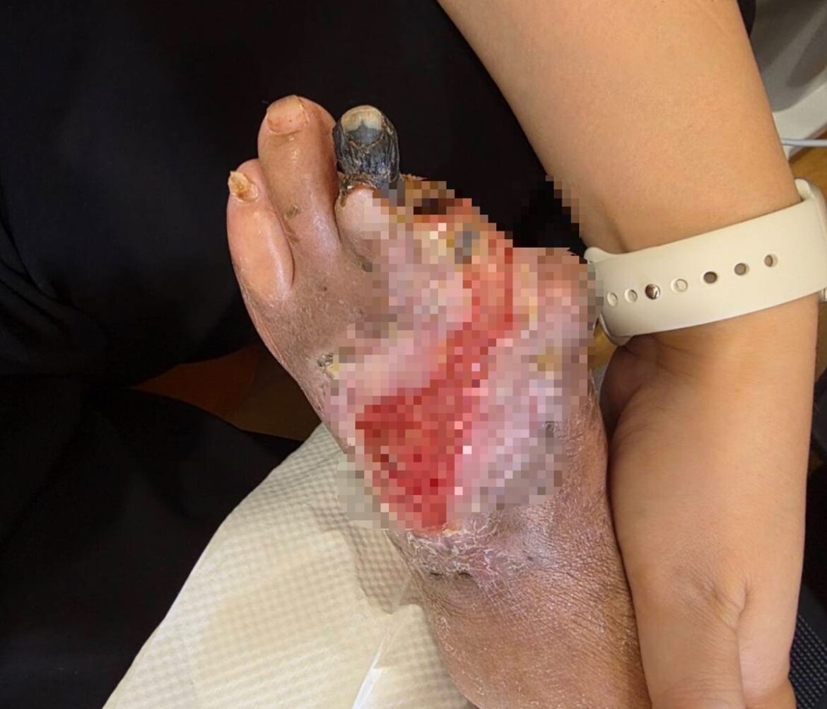 婦剪趾甲竟變截掉兩根腳趾  經歷清創靠中醫雷射針灸重新站起來